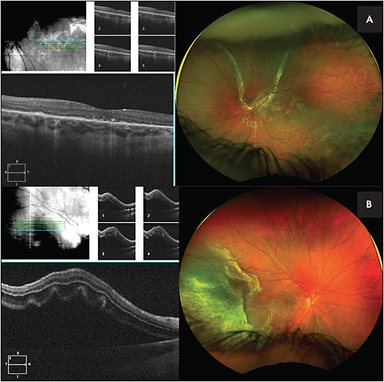 Figure 2. An 8-year-old female presented with bilateral retinal detachments, with the left eye having evidence of spontaneous resolution (A). The right eye underwent combined scleral buckle and vitrectomy surgery with placement of silicone oil (B). Postoperatively, the retina remained nicely attached but with evidence of ellipsoid zone loss on OCT. Images courtesy of Audina M. Berrocal, MD