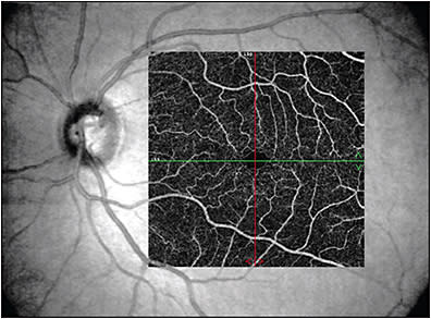 Figure 2. Optical coherence tomography angiography image of normal superficial capillary plexus centered on the fovea (left eye).