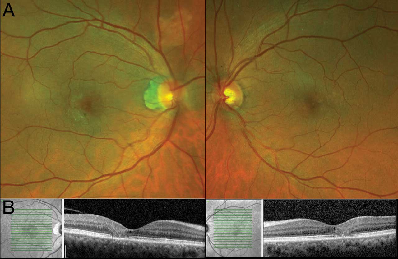 Figure 1.  Color fundus photography showing pigmentary changes temporal to the fovea (A). There are ectatic capillaries and white-appearing crystalline deposits. Optical coherence tomography scanning shows focal attenuation of the inner segment and outer segments of the juxtafoveal retina (B).