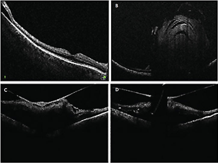 Figure 4. Microscope-integrated OCT (Enfocus; Leica Microsystems) showing the extent of peripheral subretinal fluid in retinal detachment case (A), native lens subluxation and position on the retinal surface (B), tractional membrane (C), and shadowing from a surgical instrument (D).