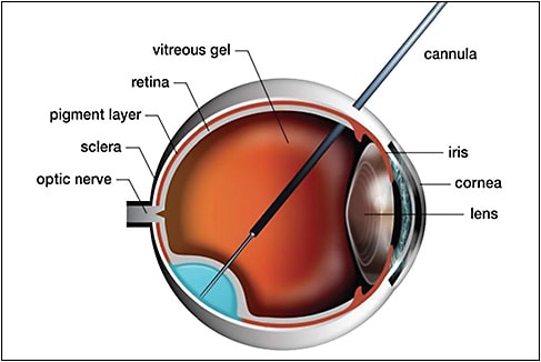 Figure 1. Subretinal injection is currently the most common surgical procedure for retinal gene therapy. Access to the subretinal space is achieved via a transretinal approach using a microneedle.
IMAGE COURTESY OF MOORFIELD’S EYE HOSPITAL