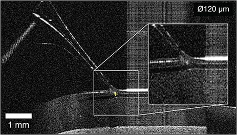 Figure 3. An example of the OCT feedback during autonomous retinal vein cannulation using the IRISS. As can be seen, the artificial 120-µm-diameter vein has been successfully cannulated by the micropipette.8