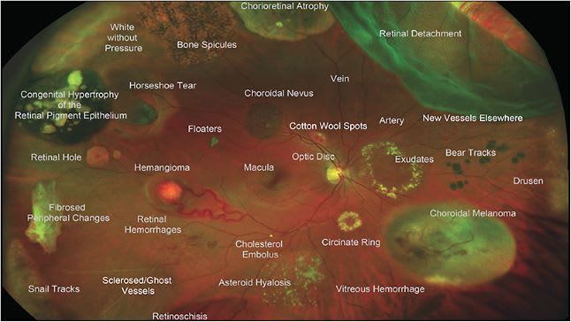 Figure 3. Labeled diagnostic atlas of retinal pathology on ultrawidefield fundus photograph. Reprint permission obtained from Optos.