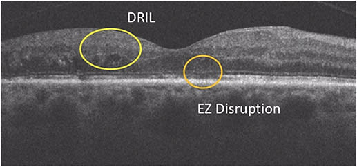 Figure 3. The integrity of the external limiting membrane and the ellipsoid zone (EZ)/outer retinal layer, and disorganization of the retinal inner layers (DRIL) have been linked to visual acuity prognosis.10
Image courtesy of Justis Ehlers, MD