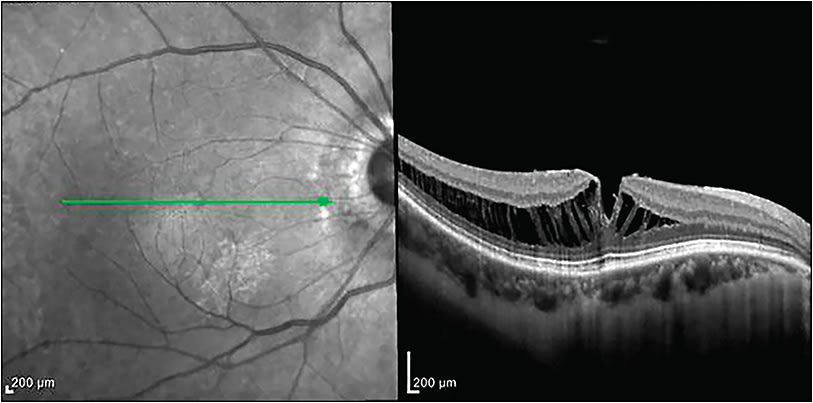 Figure 3.  Myopic traction maculopathy with maculoschisis most prominent over a staphyloma caused by the relative noncompliance of the internal limiting membrane.