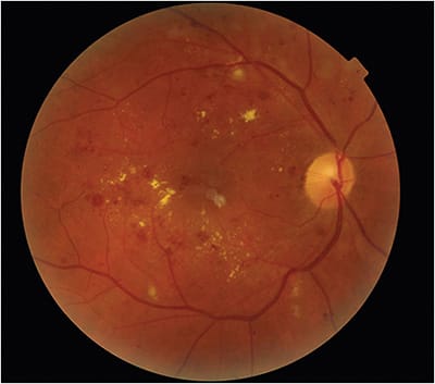 Figure 1. Diabetic retinopathy on dilated fundus exam.