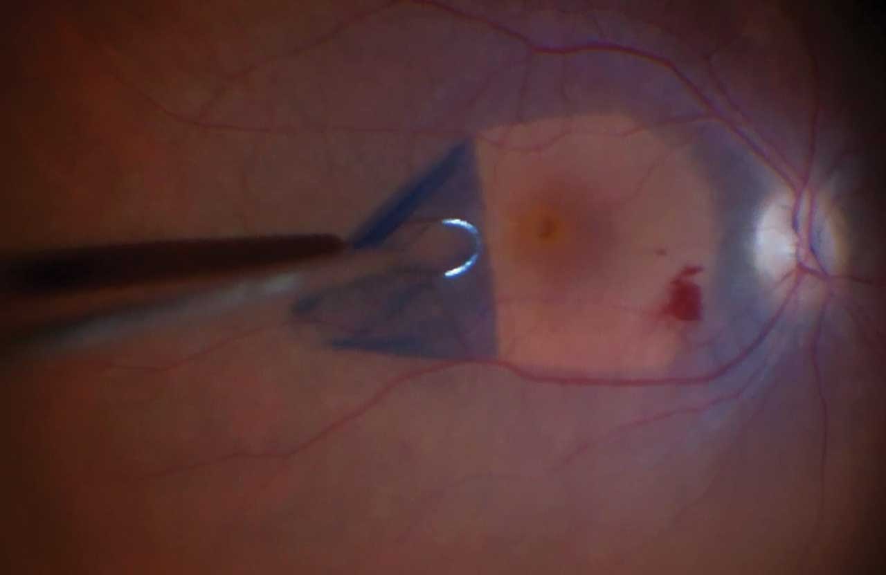 Figure 5. In the retracting-door internal limiting membrane (ILM) flap technique, the ILM is peeled nasally to temporally over the hole but is not removed.