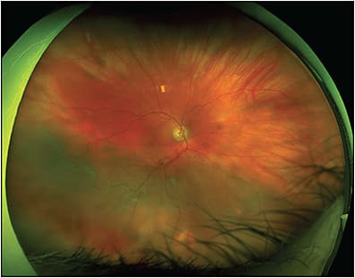 Figure 4. Optos ultrawidefield fundus photograph (A) and fluorescein angiography (B) of branch retinal vein occlusion.