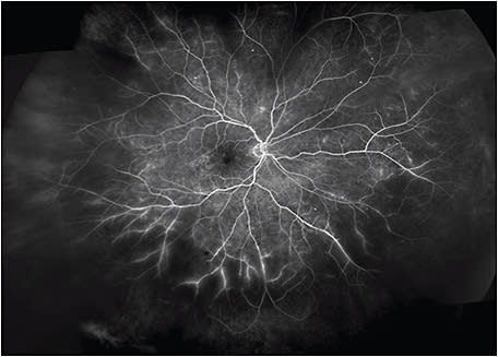 Figure 3. This montaged widefield fluorescein angiographic image shows a significantly larger area of retinal nonperfusion in the periphery in the 360° view.