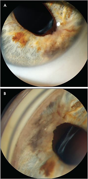 Figure 5. Slit-lamp photographs of an amelanotic iris nevus with visible intratumoral vessels, ectropion uvea and no angle involvement that has been stable for many years. Image B is captured with contact gonioprism.