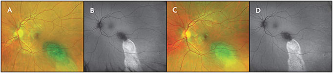 Figure 7. Widefield fundus autofluorescence. Long-standing choroidal nevus (A) demonstrating chronic leakage with &amp;#x201C;guttering&amp;#x201D; appearance (B). Note stable appearance 1 year later both on fundus photograph (C) and autofluorescence (D).