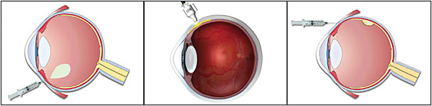 Figure 1. Routes of delivery of ocular gene therapy: intravitreal injection (A), suprachoroidal injection (B), and subretinal delivery (C).