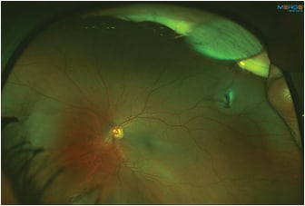 Figure 3. Fundus photo demonstrating superotemporal metal intraocular foreign body embedded in the retina of the left eye.