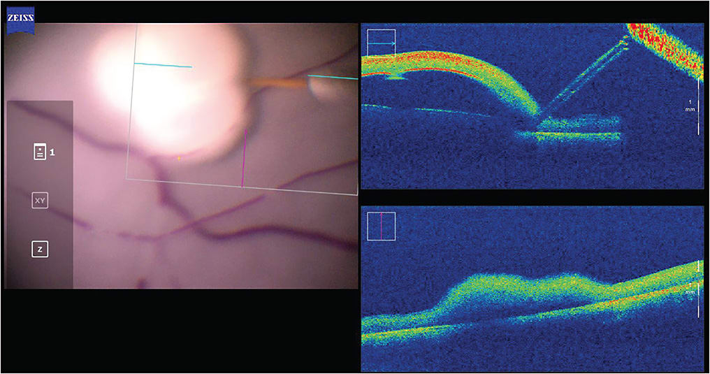 Figure 1. Subretinal bleb made in one step without reflux, this using the assistance of the Preceyes Surgical System. Image courtesy Preceyes BV