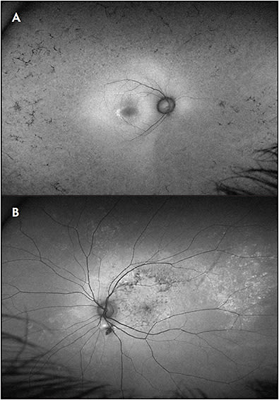 Figure 2. The fundus autofluorescence pattern in a patient with RP (A) demonstrates the midperipheral hypoautofluorescence that mirrors the extent of the ring scotoma that is found on visual field testing. There is a hyperautofluorescent macular ring that corresponds to a loss of outer retinal bands that is evident on OCT imaging. Patients with such hereditary retinopathies tend to have disease that progresses about a central fulcrum at the fovea, and symmetry in findings between eyes. In contrast, the fundus autofluorescence pattern in a patient with congenital rubella (B) demonstrates a less ordered distribution of fundus abnormalities that is often seen in acquired pigmentary retinopathies.