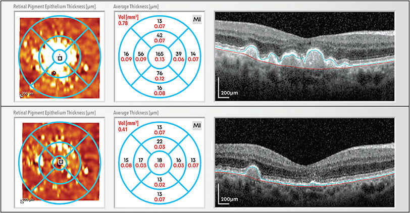 Figure 2. A representative optical coherence tomography B-scan (right) and retinal pigment epithelium/drusen thickness map (left) of a patient with intermediate AMD. Top: baseline images prior to treatment with photobiomodulation show a drusen volume of 0.78 mm3. Bottom: after 1 year and 2 rounds of PBM treatment, an overall reduction of drusen volume (0.41 mm3) is seen.17