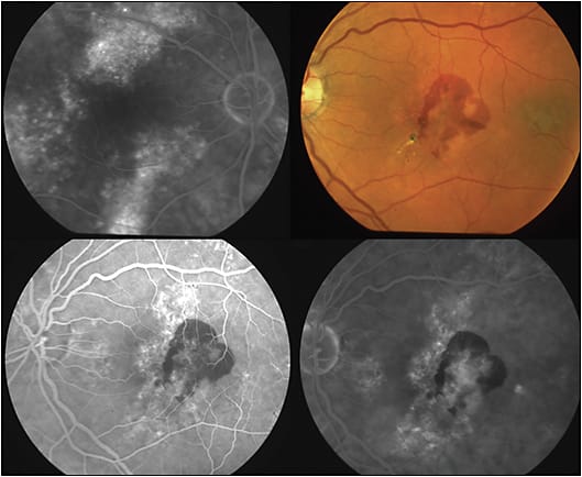 Figure 4. Choroidal neovascularization (CNV) associated with CSC, left eye. Top left, fluorescein angiography (FA) showing RPE atrophic tracks (“gutters”), right macular region, in a patient with chronic CSC. Top left, subretinal hemorrhage in the patient’s fellow eye. Bottom left, early FA frame, bottom right, late FA frame, showing subfoveal CNV associated with the submacular hemorrhage in the region of RPE disruption associated with chronic CSC.