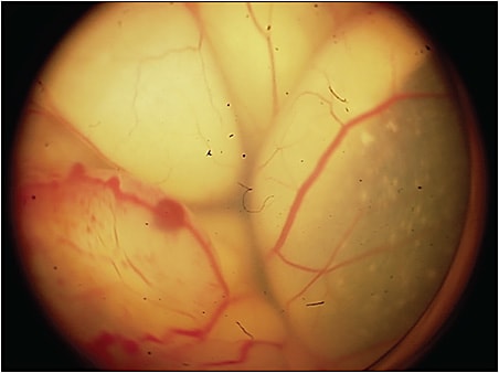Figure 2. An eye with Coats disease simulating retinoblastoma.