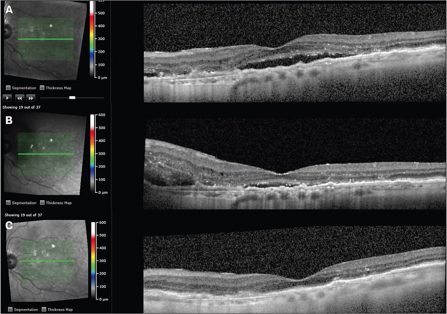 Figure 1. OCT showing persistent subretinal and intraretinal fluid despite q4 week ranibizumab therapy (A). New subretinal peripapillary hemorrhage prompted a switch to intravitreal aflibercept therapy (B). Resolution of subretinal hemorrhage, subretinal fluid, and intraretinal fluid after 6 doses of intravitreal aflibercept in a treat-and-extend method (C).