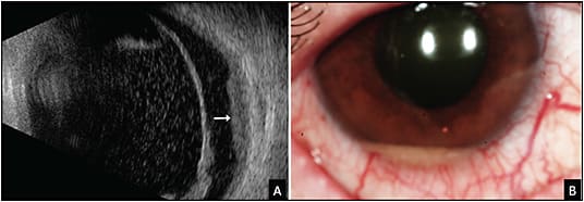 Figure 6. A 55-year-old male patient developed blurred vision in his right eye. His systemic history included bladder cancer that was treated with surgery and chemotherapy 4 years prior.