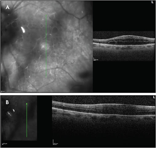 Figure 3. Diffuse macular edema, right eye (A). Same eye 4 weeks after intravitreal triamcinolone acetonide 2 mg (B).
