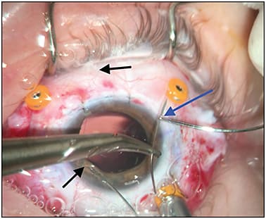 Figure 4. The second 9-0 Prolene suture is loaded into the suture passer. The CIF needle is passed through the eyelet (blue arrow). The black arrows show the first 9-0 Prolene suture that was already passed through the 2 sclerotomies and the IOL eyelet. The CIF needle is used to weigh down the end of the first 9-0 Prolene suture.