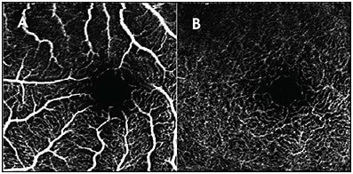 Figure 3. Artifact due to the retina being out of focus shown on the OCTA superficial vascular complex (A) and deep vascular complex (B). Note the widened vasculature and diffuse blurriness that causes the microvasculature to fade into the background.