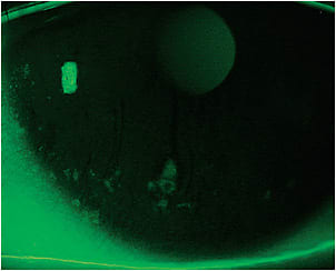 Figure 1. Showing patients an image of their ocular surface can help them understand why their eyes feel dry.