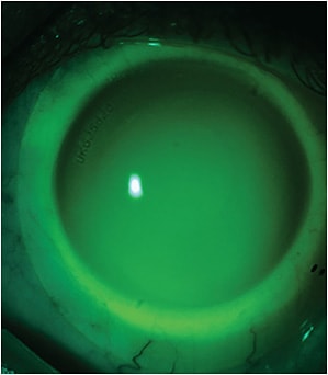 Figure 12. Scleral lens on the left eye demonstrating inferior temporal decentration along a steep scleral axis as well as superior nasal edge lift. Image courtesy of Jason Jedlicka, OD