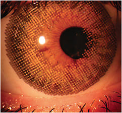 Figure 1. An off-the-shelf colored contact lens that is used as a prosthetic lens to color-correct an underlying iris scar secondary to trauma.