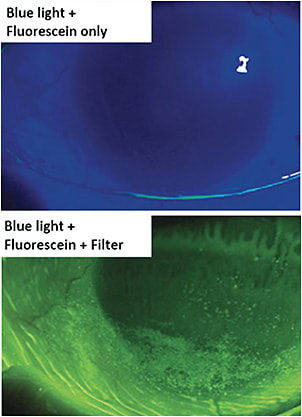 Figure 2. View of fluorescein staining without and with a yellow barrier filter.