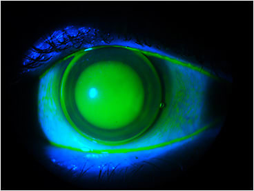 Figure 4. The steeper corneal GP to vault the scar.