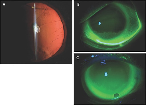 Figure 1. (A) A young patient who has congenital aniridia and (B) secondary LSCD from aniridic keratopathy. (C) Scleral lenses with autologous serum tears in the vault of the lens were prescribed to protect the ocular surface. Photos taken by Marissa Gomez, OD