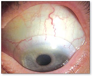 Figure 1. A scleral lens for a 10.00D post-LASIK surgery patient.