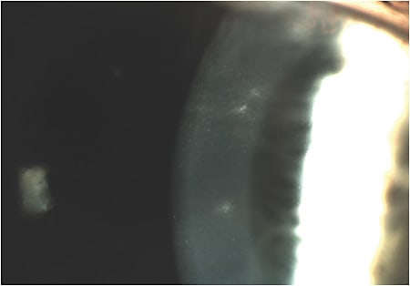 Figure 2. Scattered granular infiltrates consistent with sterile corneal&#xD;&#xA;infiltrative events (CIEs).