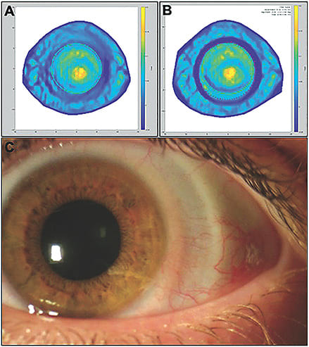 Figure 1. Scleral lens settling and compression. Topographical colorimetric maps taken with the sMap3D (Visionary Optics) show the conjunctival/scleral elevation before SL wear (A) and after several hours of SL wear (B). The green circle marks the limbus, and the dark blue ring shows the area of conjunctival depression after SL wear. After removal of the SL, an area of compression can be observed where the SL lands (C). Images courtesy of Dr. Gregory W. DeNaeyer