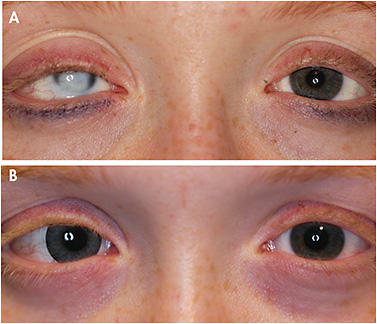 Figure 7. (A) shows an eye that has congenital microphthalmia (Coats’ disease) with opacification of the cornea, and (B) shows the same eye with a hand-painted soft prosthetic spherical lens.