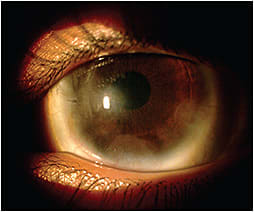 Figure 1. Scleral lens correction of irregular astigmatism from corneal scarring due to pediatric ocular chemical burn.