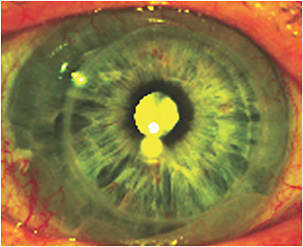 Figure 1. Conjunctival prolapse of a patient upon initial presentation.