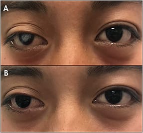 Figure 1. (A) A dark-brown-eyed patient who has a central corneal scar of the right eye from Peters anomaly; (B) the same patient with a brown translucent colored lens that effectively masks the scar.