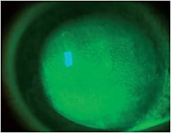 Figure 1. Punctate keratitis of a patient with NK prior to scleral lens wear.