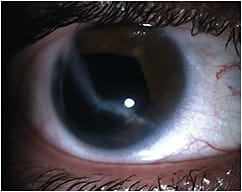 Figure 2. OD with functional vision and acquired partial aniridia.