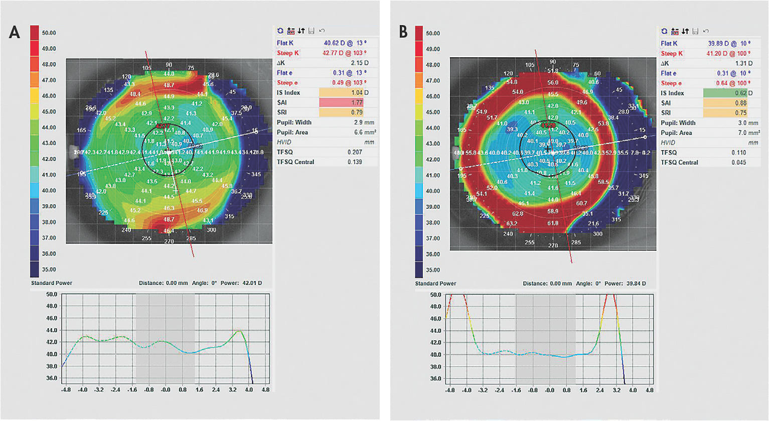 Figure 5. Modern ortho-k allows for correction of residual refractive error after LASIK treatment. (Right) Note the increase in central treatment zone size after ortho-k wear compared to (left) before wear.