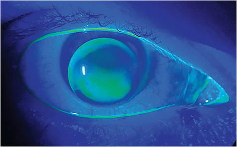 Figure 2. GP multifocal lens on eye.