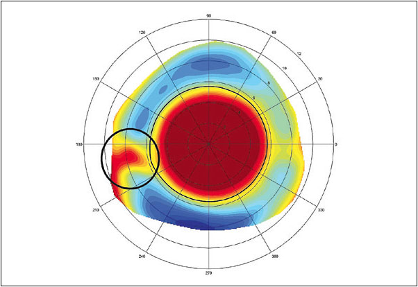 Figure 1. Scleral elevation map OS. The nasal red spot highlights the pinguecula