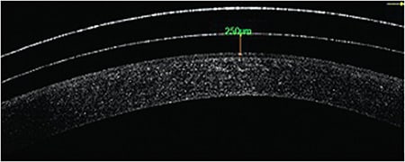 Figure 2. Balancing scleral lens vault, center thickness, and power of the lens will decrease aniseikonia. Image courtesy of Claudia Hnulik, BS