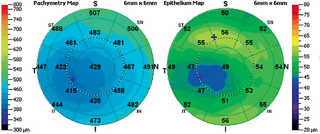 FIgure 10. OCT pachymetry maps of keratoconus. The thinning of the epithelium matches location with apical thinning.