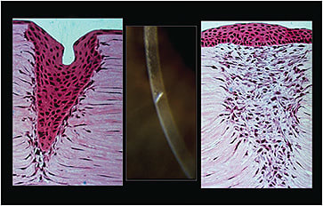 Figure 3. The left image shows an epithelial plug formed within the walls of the gaping wound. With time, the plug is pushed out and replaced with scar tissue.