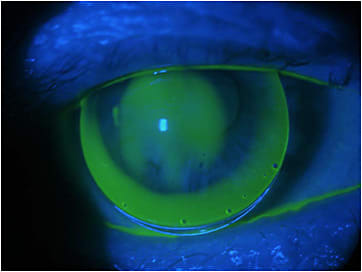 Figure 6. Specialty RGP lens fitting OD. There was no apical touch. He had a visual acuity of 20/30-2.