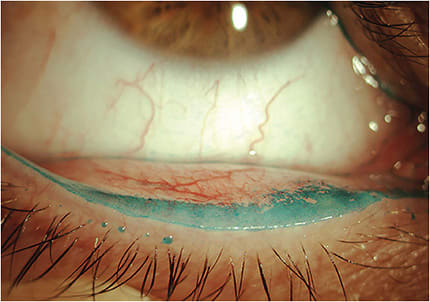 Figure 2. Scleral lenses can exacerbate lid wiper epitheliopathy.